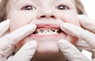 γιορτές: τι επιπτώσεις έχουν στα δόντια μας